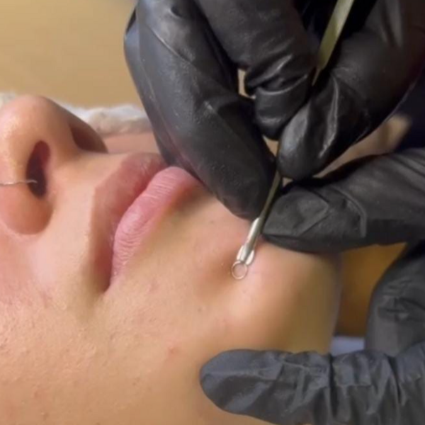 Limpieza facial con extracciones