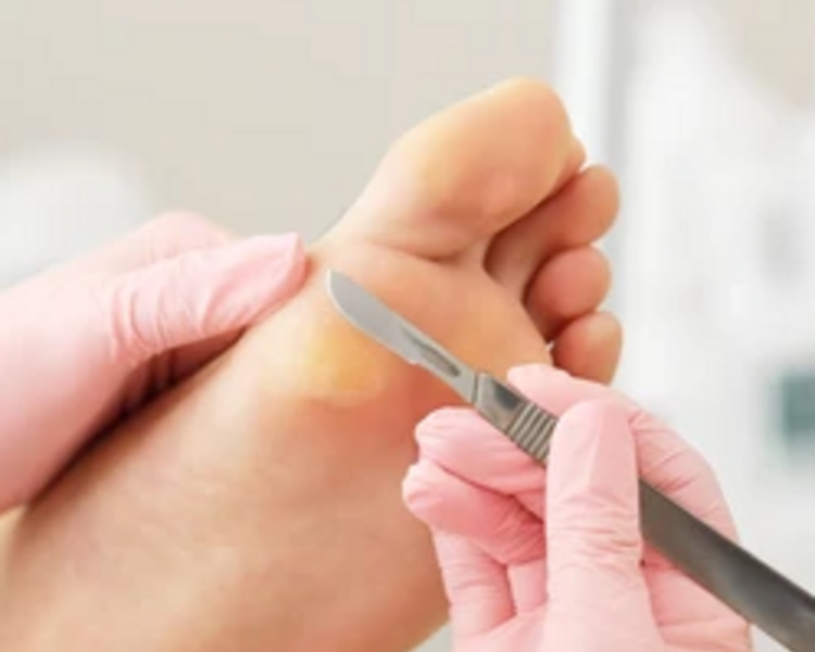 Pedicuría con Bisturí sin esmaltado