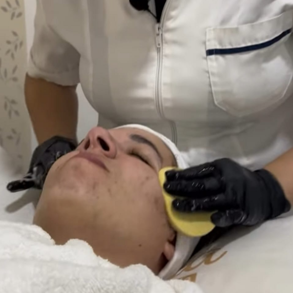 Peeling Químico  Cosmiatrico