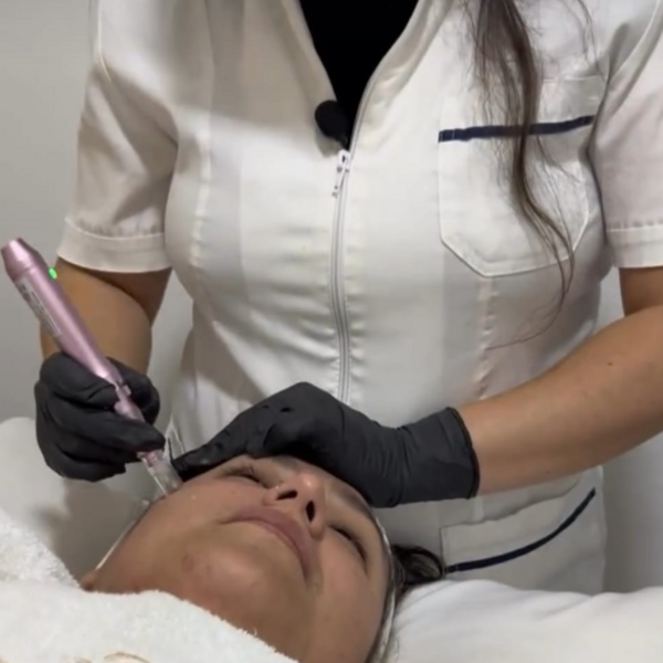 Microneedling con Dermapen