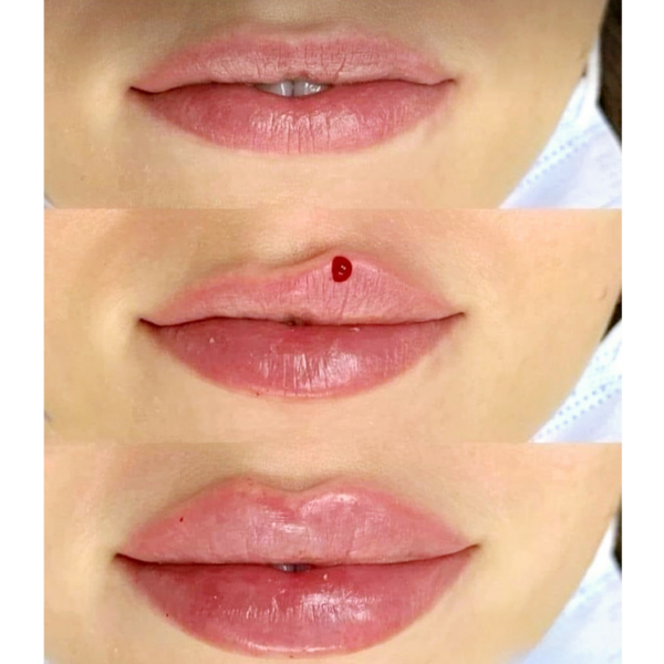 Relleno de Labios Restylane