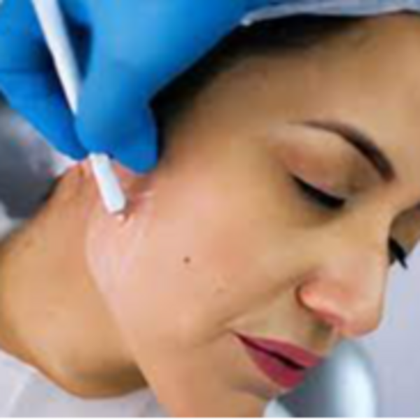 Toxina Botulínica Para Tratamiento de Bruxismo