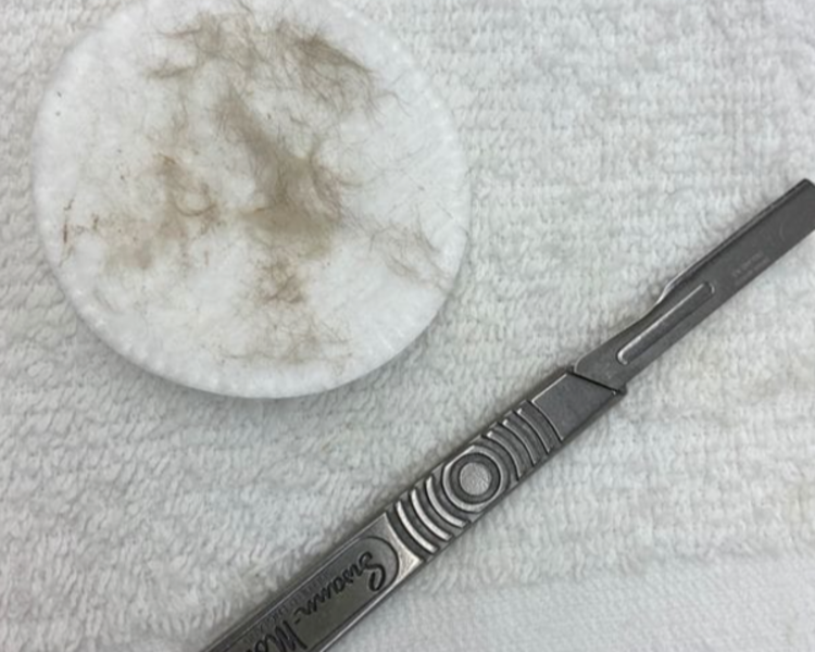 Dermaplaning
