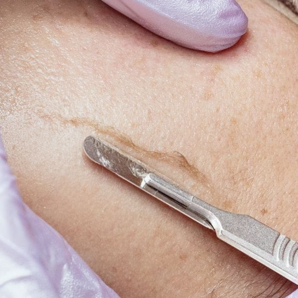 Dermaplaning