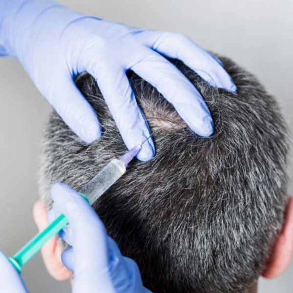 Recuperación Médica Capilar con Plasma Rico en Plaquetas PRP