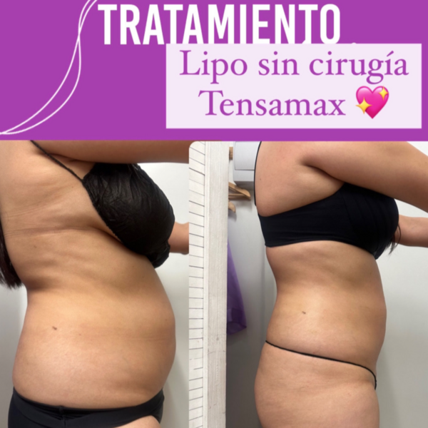 Hidrolipoclasia + Tensamax 3 sesiones
