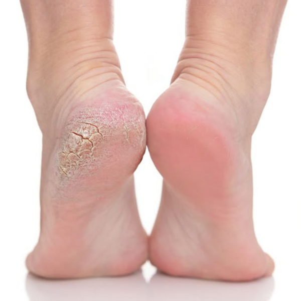 Adicional hiperqueratosis o uñas encarnadas