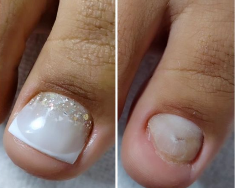 Pedicuría clinica con reconstrucción de uñas