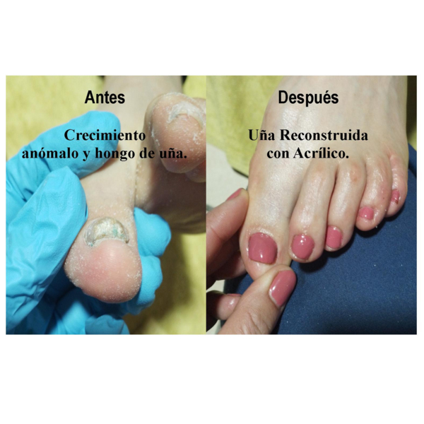 Podologia + reconstrucción de uña  con acrílico.