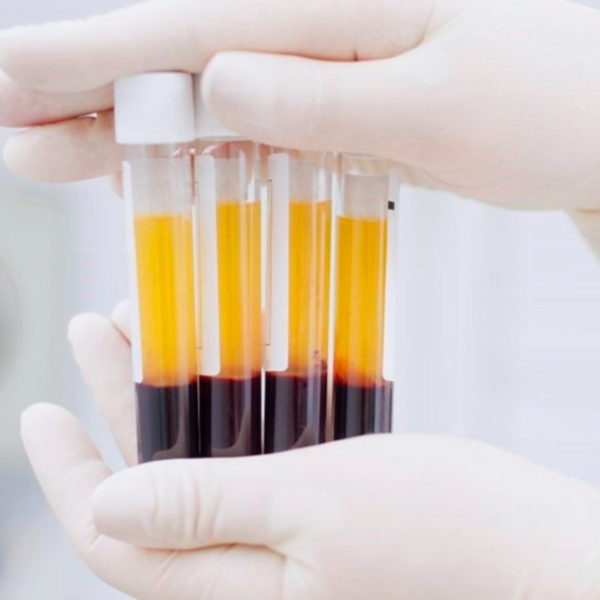 Plasma rico en plaquetas Capilar