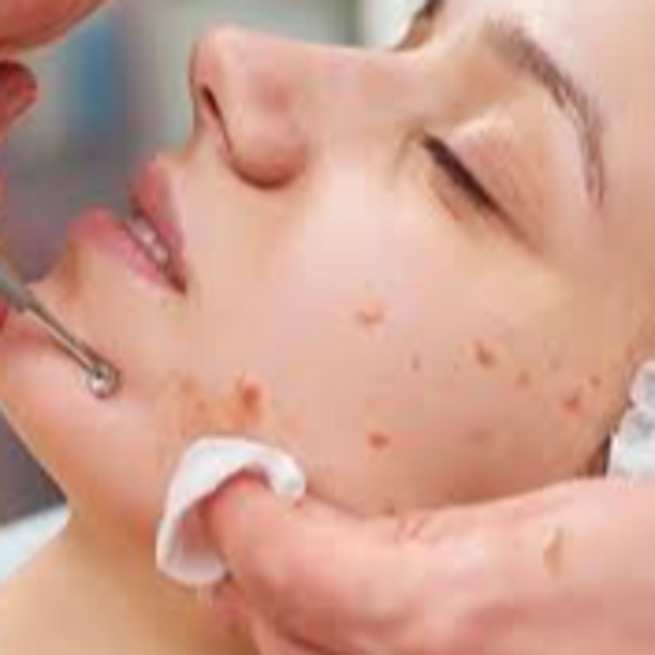 LIMPIEZA FACIAL (TRATAMIENTO PARA ACNÉ)