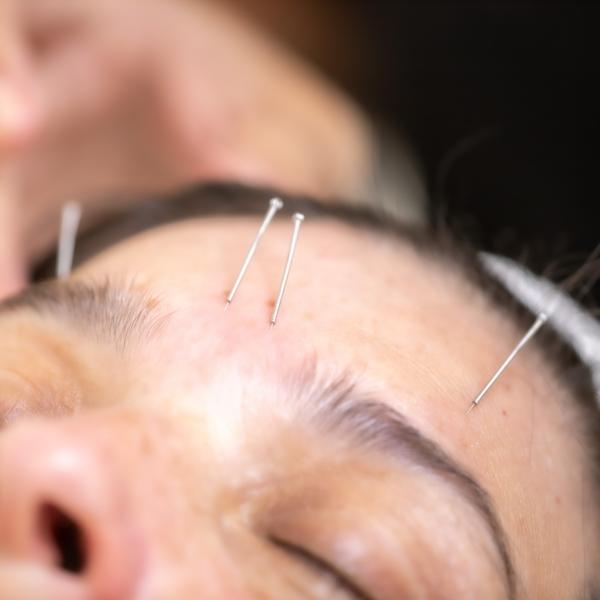 Acupuntura Facial