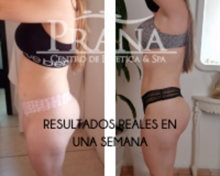 Tratamiento Corporal Modelado de Silueta