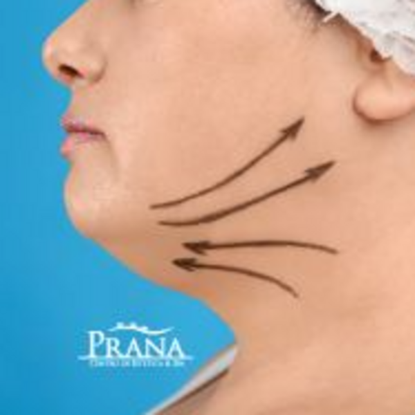 Post-Operatorio Papada