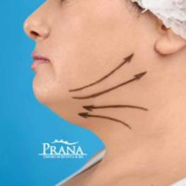 PQT Post-Operatorio Papada