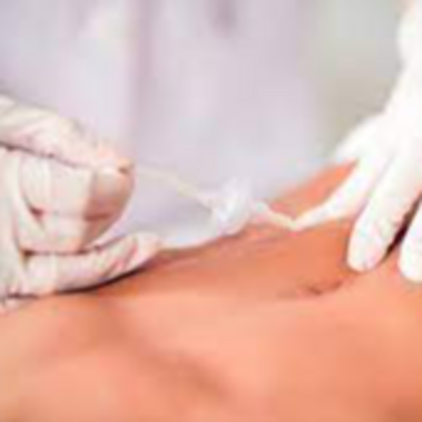 Carboxiterapia abdomen, cintura (1 sesión)