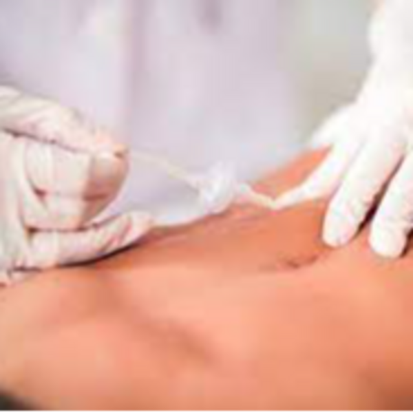 Carboxiterapia abdomen, cintura (5 sesiones)