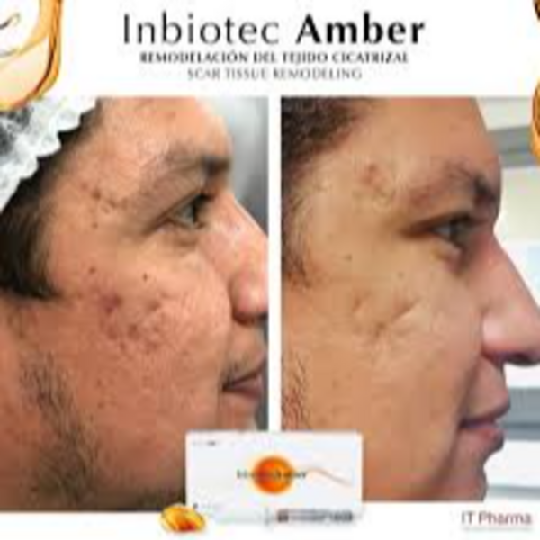 Mesoterapia para atenuación de cicatrices de acne