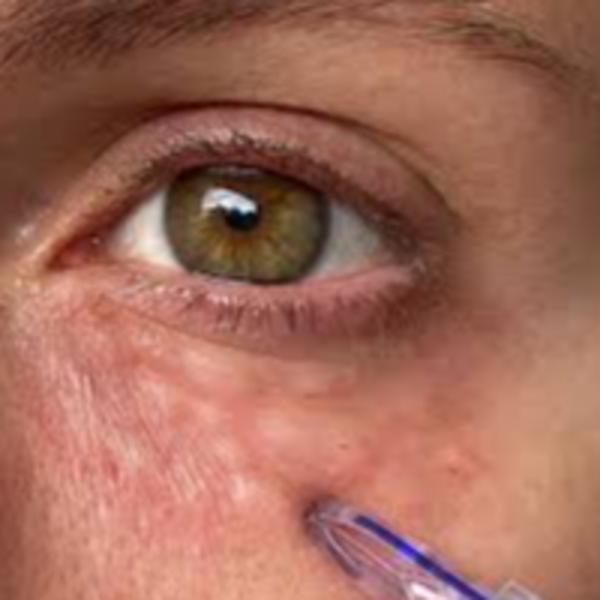 Mesoterapia Nutrición de ojeras 