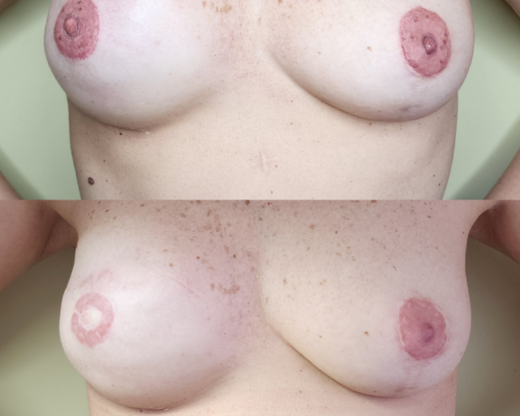 MICROPIGMENTACION PARAMEDICA