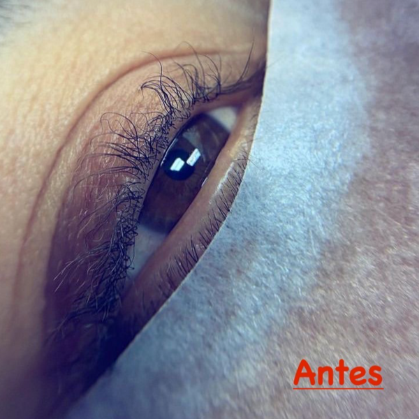 Reversa de lifting y tratamientos con cóctel de botox y vitaminas 