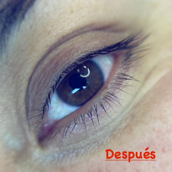 Reversa de lifting y tratamientos con cóctel de botox y vitaminas 