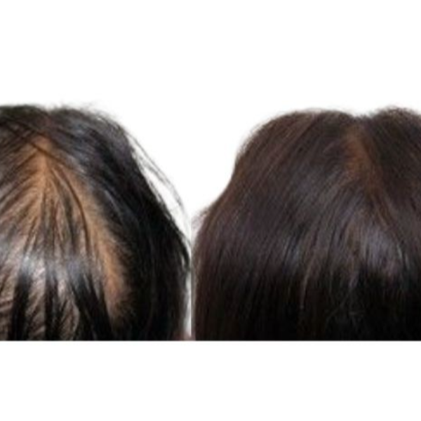 Scalp (Micropigmentacion capilar)