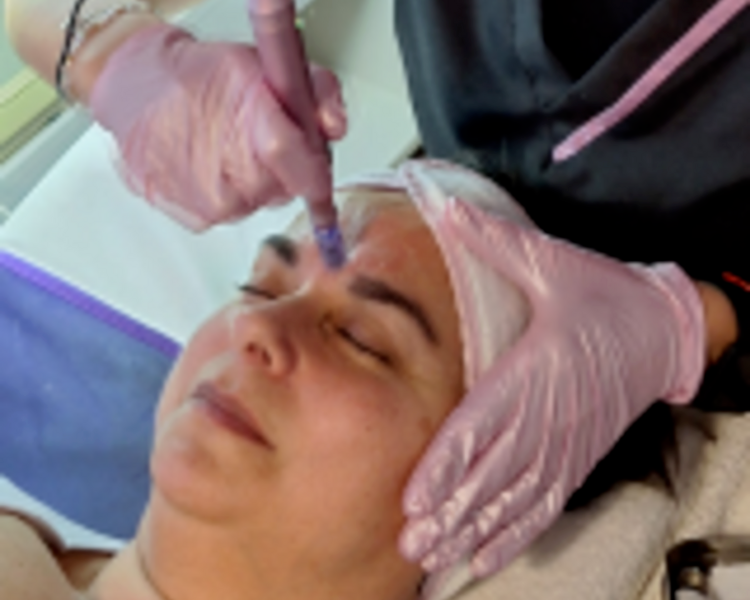 Dermapen con o sin presoterapia