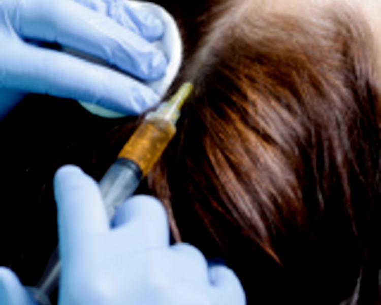 Plasma rico en plaquetas Capilar