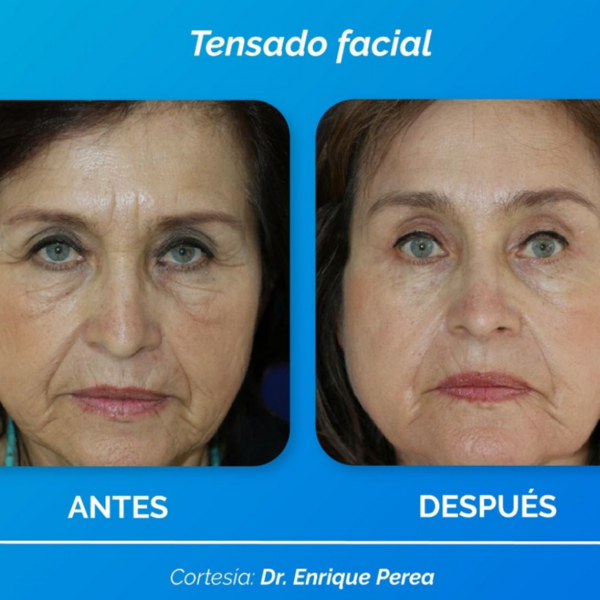 fixer radiofrecuencia fraccionada 
