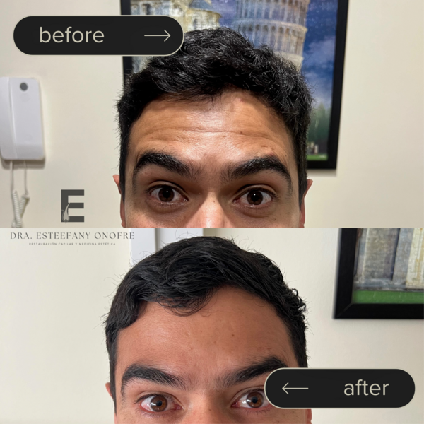 Tratamiento Facial con Toxina Botulínica