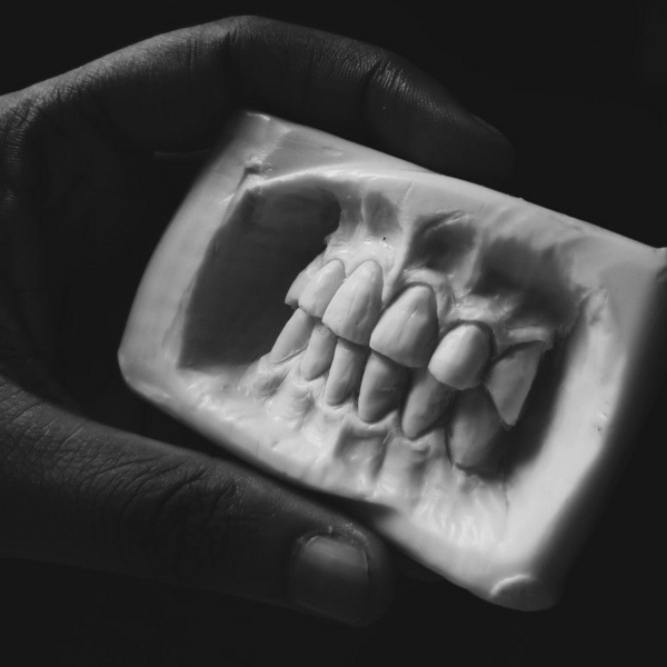 Tratamiento para bruxismo con toxina botulínica 