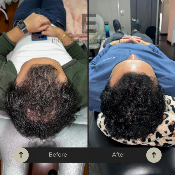 Mesoterapia con BCN - Bioestimulación Folicular 