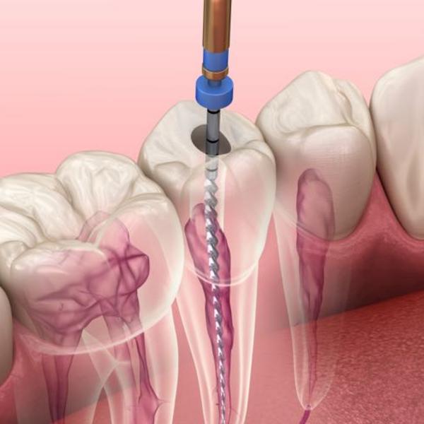Endodoncia 