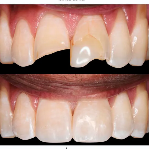 Reconstruccion de pieza dental 