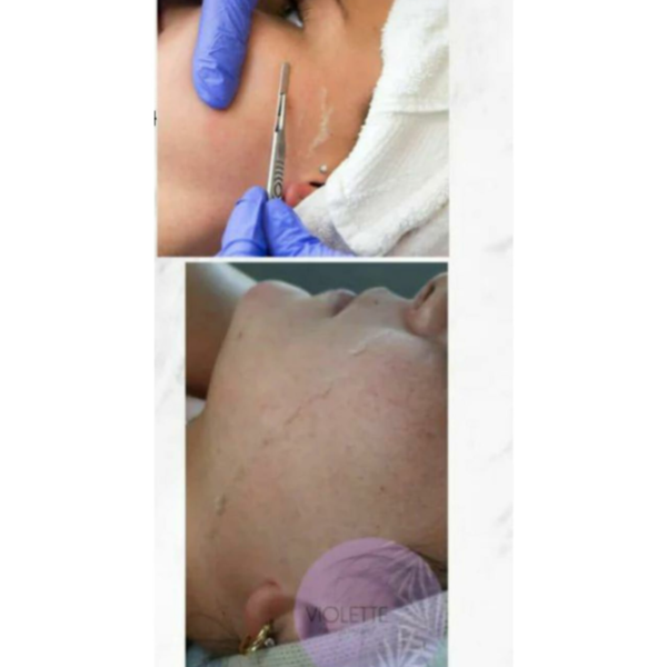Higiene Prof. con Dermaplaning