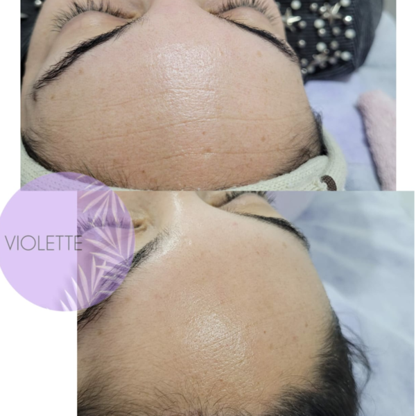 Tratamiento Biomimetico- Dermatocosmiatria