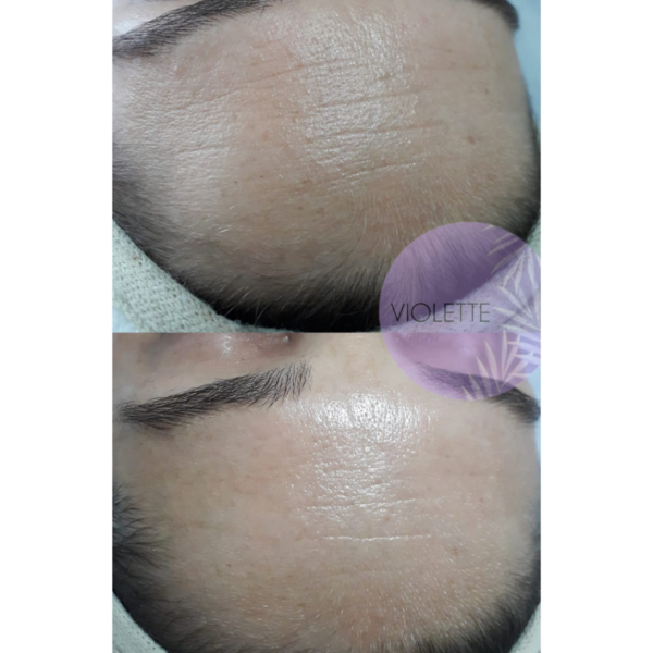 Tratamiento Biomimetico- Dermatocosmiatria