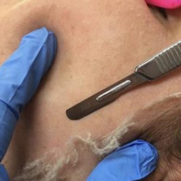 Sesión de Dermaplaning 