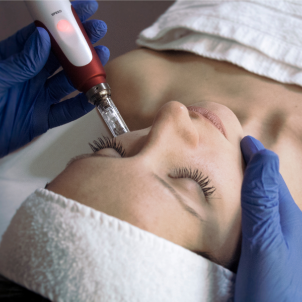 Sesión Microneedling