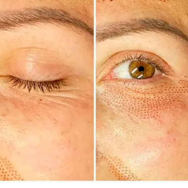 Reducción de Bolsas, Párpados y Surcos con Plasma Fraccionado 1 Sesión 