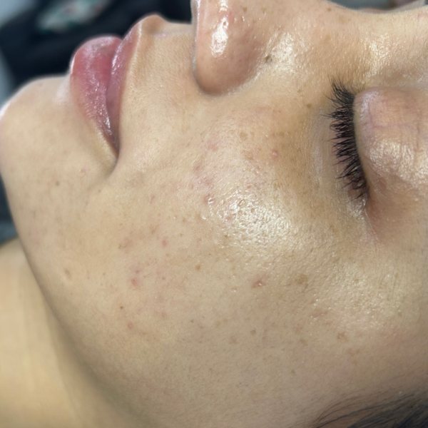 Peeling quimico cosmiatrico otoño invierno 