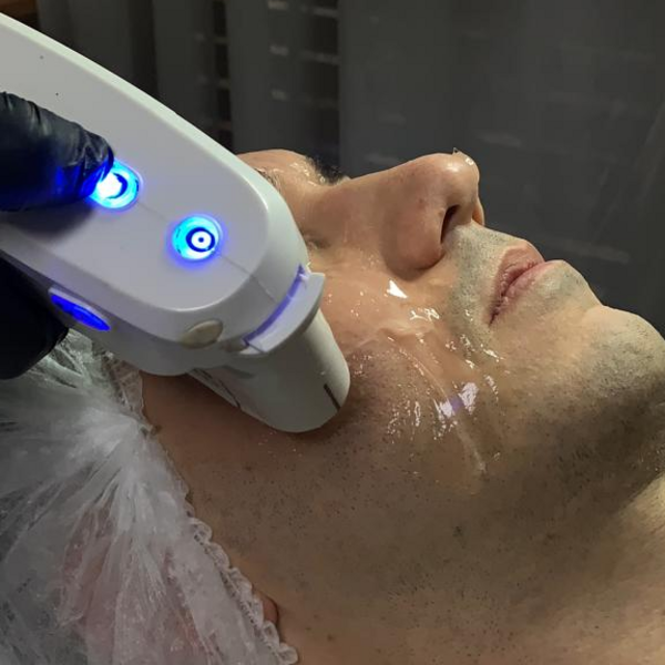 Hifu facial
