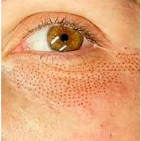 Fibroblast Parpados Inferiores y Patas de gallo