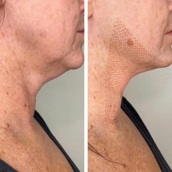 Fibroblast Flacidez Doble Mentón