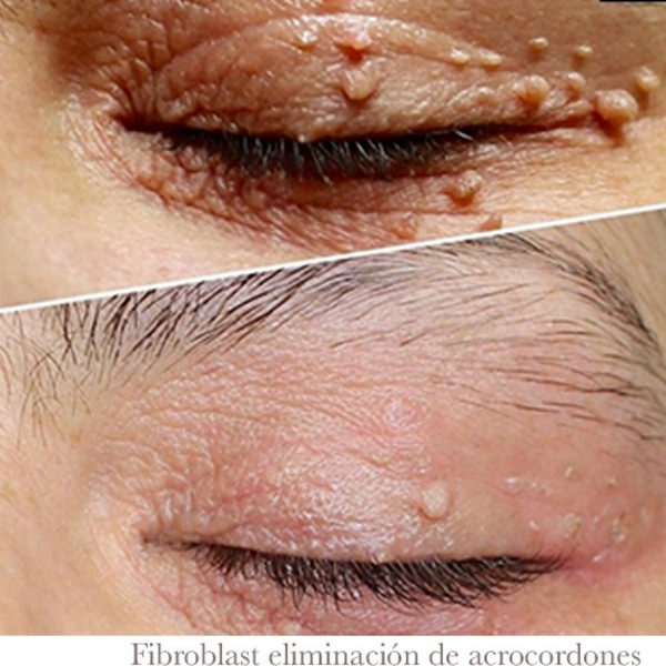 Fibroblas eliminación de lunares y/o acrocordones