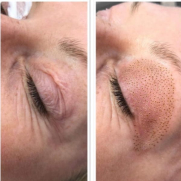 Fibroblas Flacidez Parpados Superiores