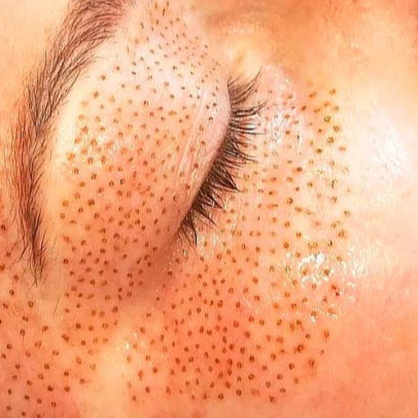 Fibroblast parados Superiores, Inferiores y Patas de Gallo