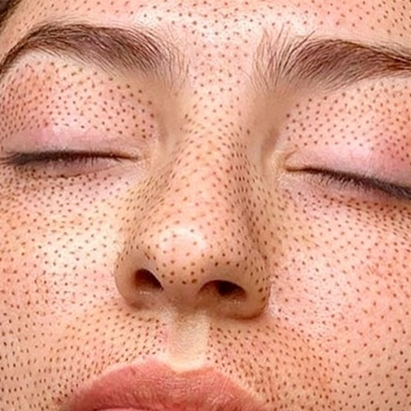 Fibroblast Rostro Completo