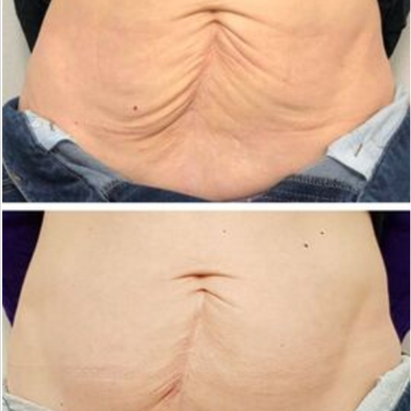 Fibroblast Flacidez Abdomen